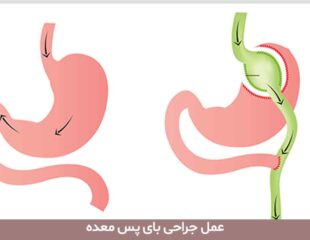 عمل جراحی بای پس معده