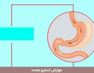 عوارض اسلیو معده