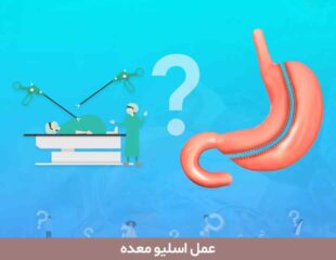 عمل اسلیو معده