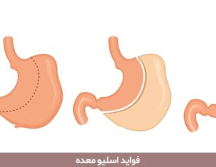 فواید اسلیو معده