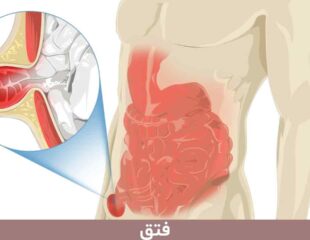 فتق یا هرنی