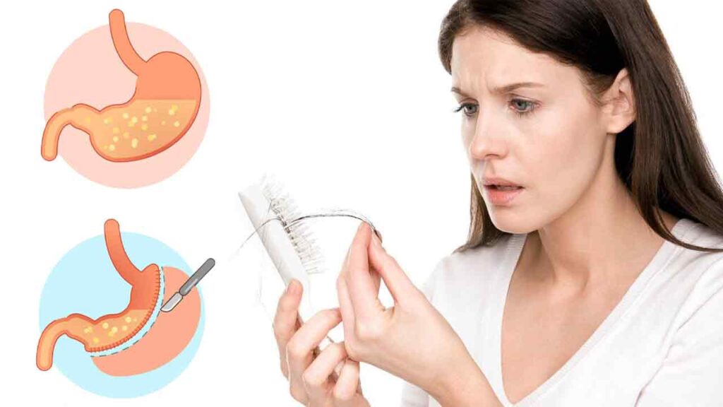 روش ‌های پیشگیری از ریزش مو بعد از عمل اسلیو معده
