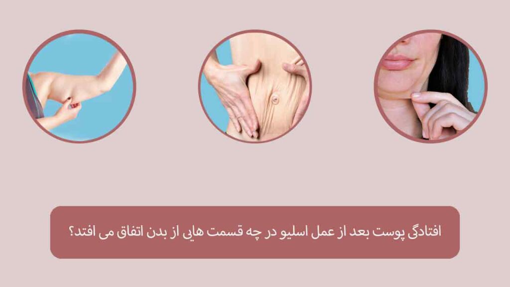 افتادگی پوست بعد از عمل اسلیو در قسمت های مختلف بدن