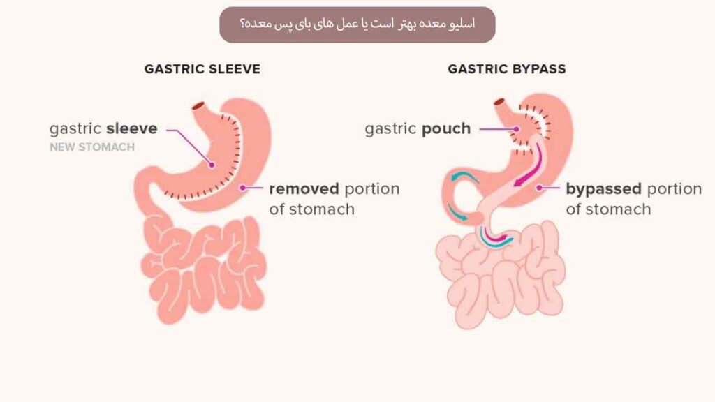 اسلیو معده بهتر است یا عمل های بای پس معده؟