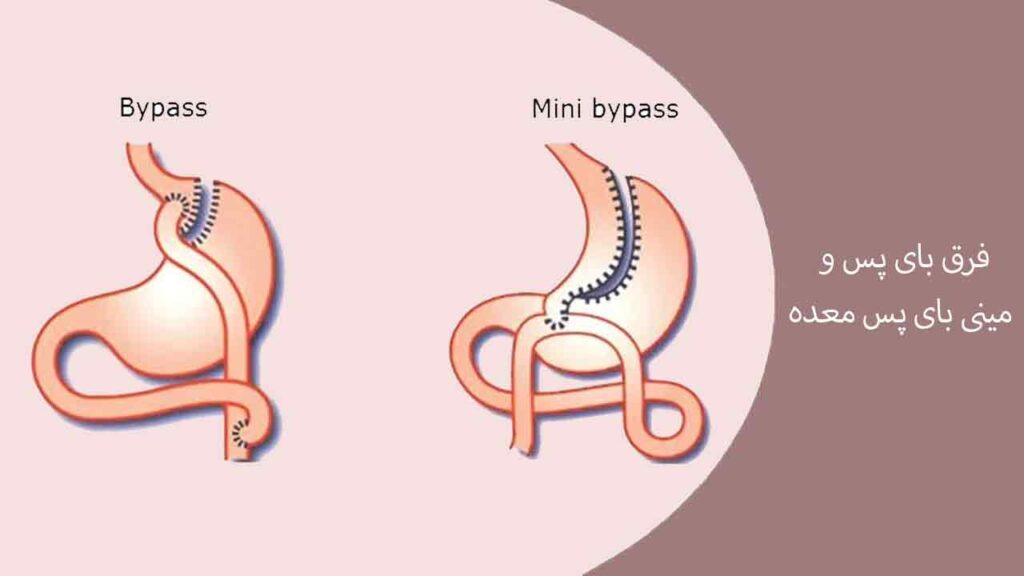 فرق بای پس و مینی بای پس معده