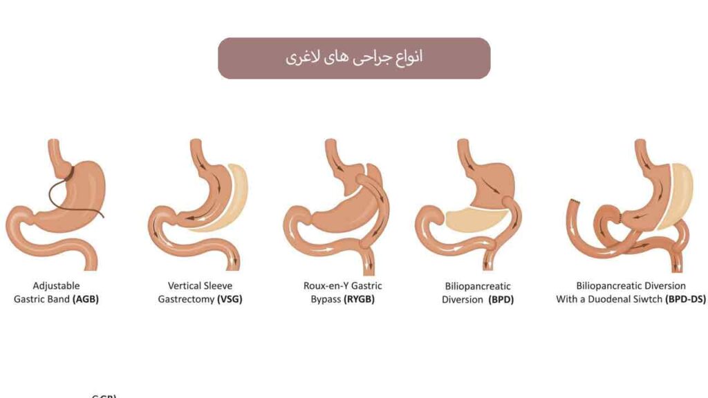 انواع جراحی های لاغری