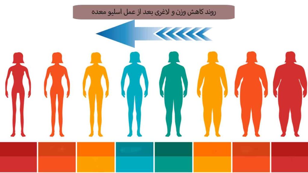 روند کاهش وزن و لاغری بعد از عمل اسلیو معده