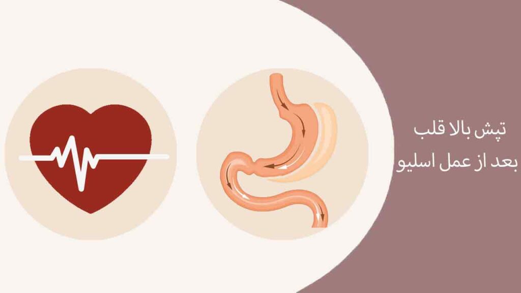 تپش بالا قلب بعد از عمل اسلیو
